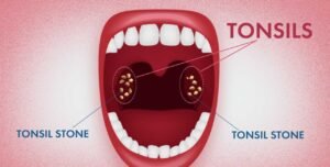 Understanding Tonsil Stones: The Basics Before You Pop
