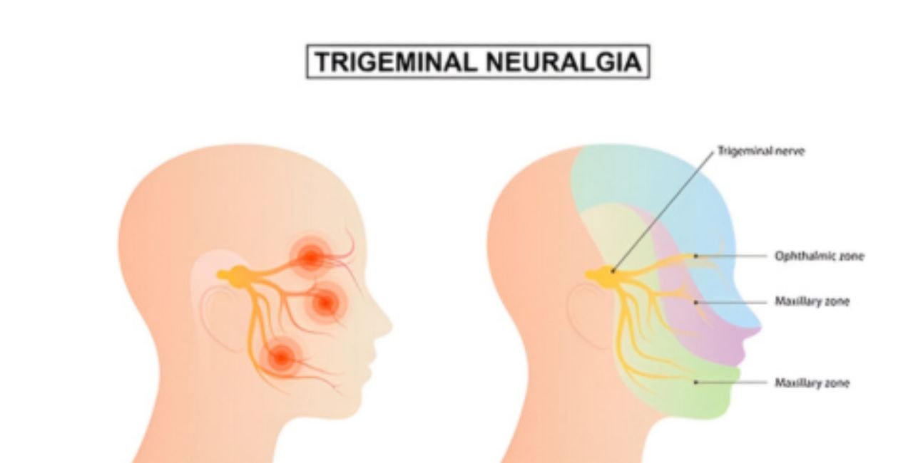 Understanding Trigeminal Neuralgia Basics