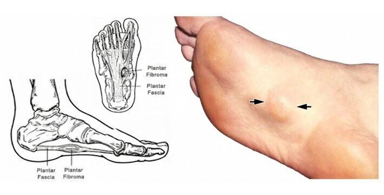 What Is Plantar Fibroma and Plantar Fibromatosis?