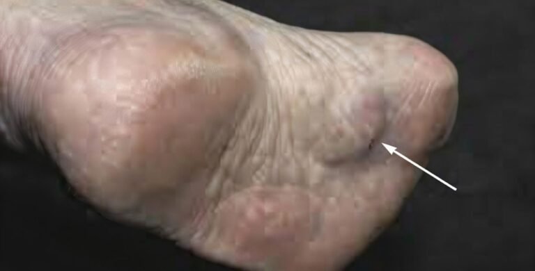 plantar fibroma and plantar fibromatosis